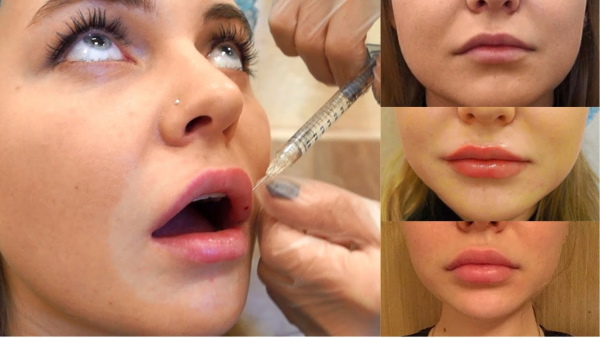 Les filles ont des lèvres fines. Comment augmenter avec de l'acide hyaluronique, un remplisseur, du botox