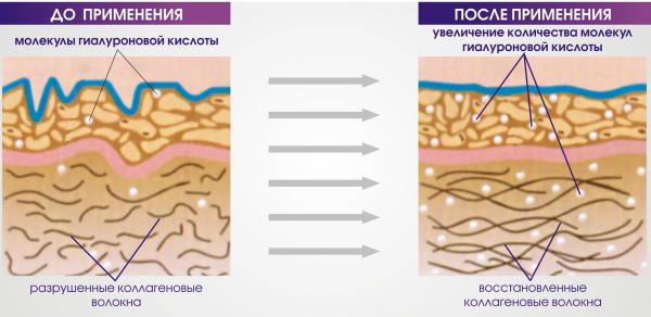 Les filles ont des lèvres fines. Comment augmenter avec de l'acide hyaluronique, un remplisseur, du botox