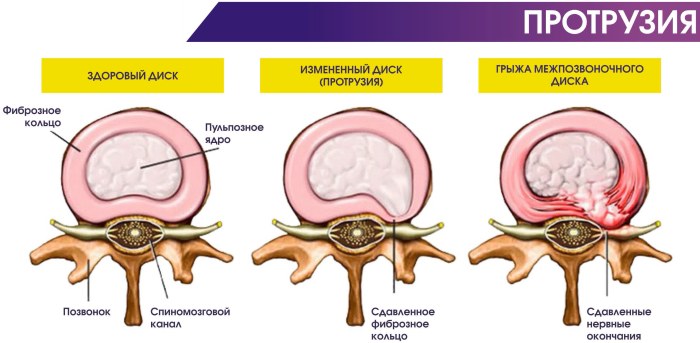 Rangée de barres en T repliées. Quels muscles travaillent, technique d'exécution